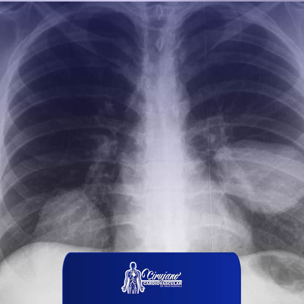 Cirugía Pulmonar por VATS