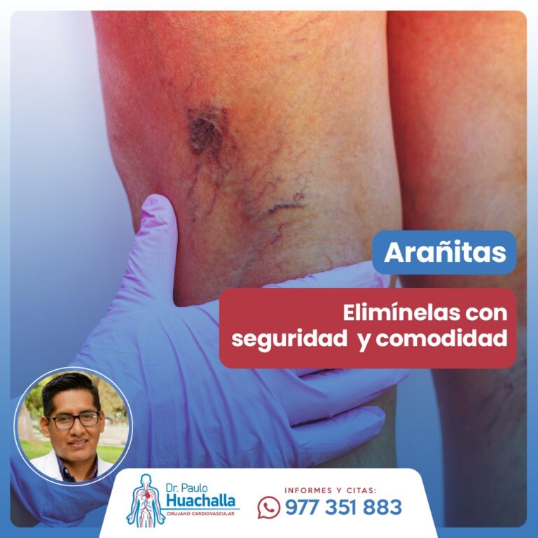 elimine aranitas vasculares en las piernas