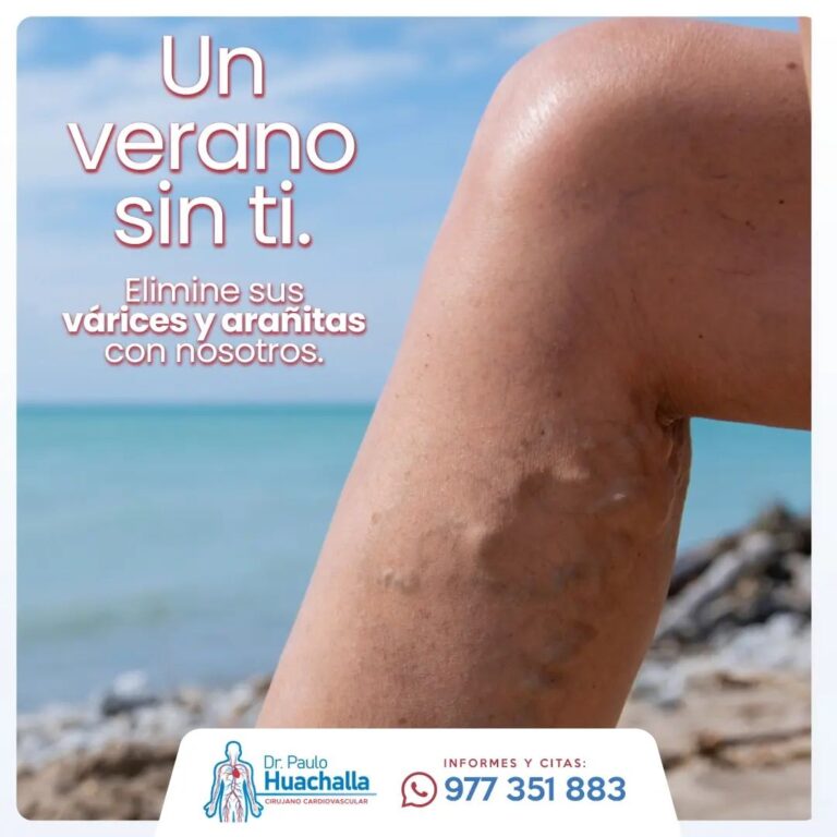 un verano sin varices