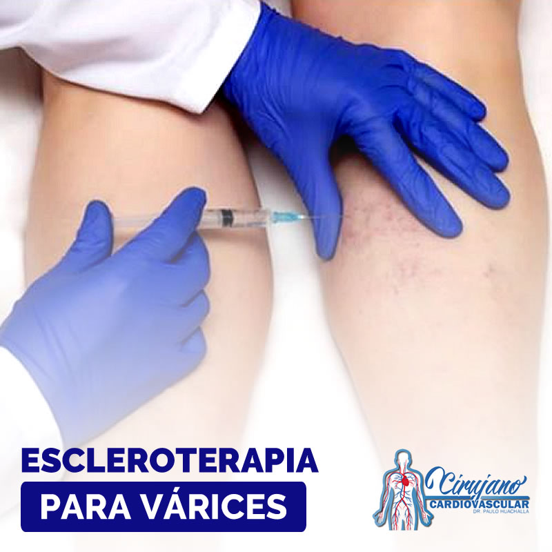 ¿En qué consiste la escleroterapia para tratar las várices? ¿En qué consiste la escleroterapia para tratar las várices?