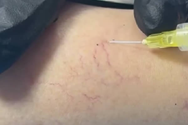 Tipos de Várices: Fotos y Videos