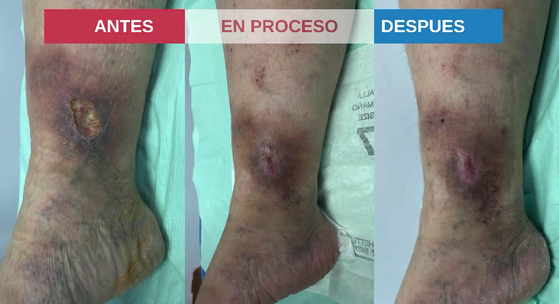 Tipos de problemas derivados de las várices, las úlceras varicosas Tipos de problemas derivados de las várices, las úlceras varicosas