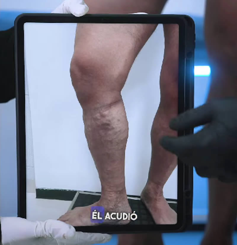 Testimonio de Paciente Satisfecho en Tratamiento de Várices Testimonio de Paciente Satisfecho en Tratamiento de Várices