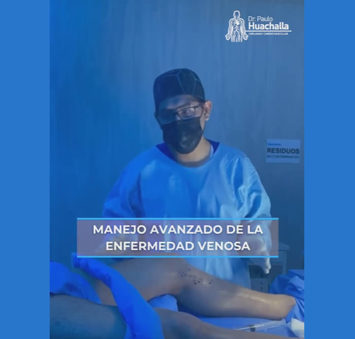 Procedimiento Mínimamente Invasivo para Várices