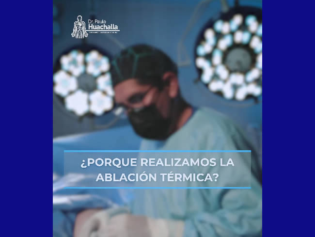 ¿Por qué realizamos la ablación térmica para tratar las várices?