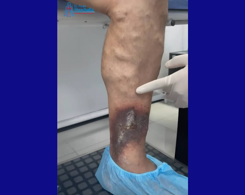 Why You Shouldn’t Delay Varicose Vein Treatment