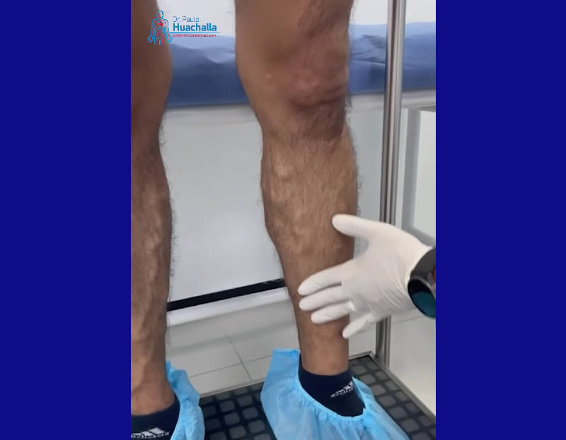 Why Sclerotherapy Is Not Suitable for All Types of Varicose Veins
