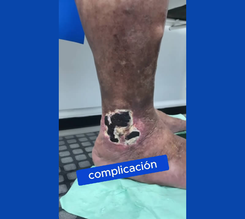 Paciente llega de otro centro médico con una úlcera post escleroterapia