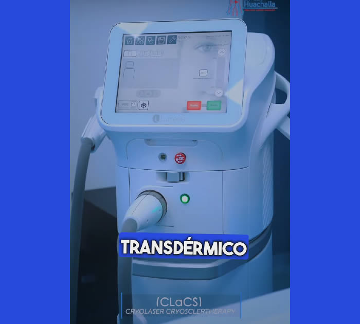 Spider Vein (Telangiectasia) Treatment with the Best Technology – CLaCS Spider Vein (Telangiectasia) Treatment with the Best Technology – CLaCS