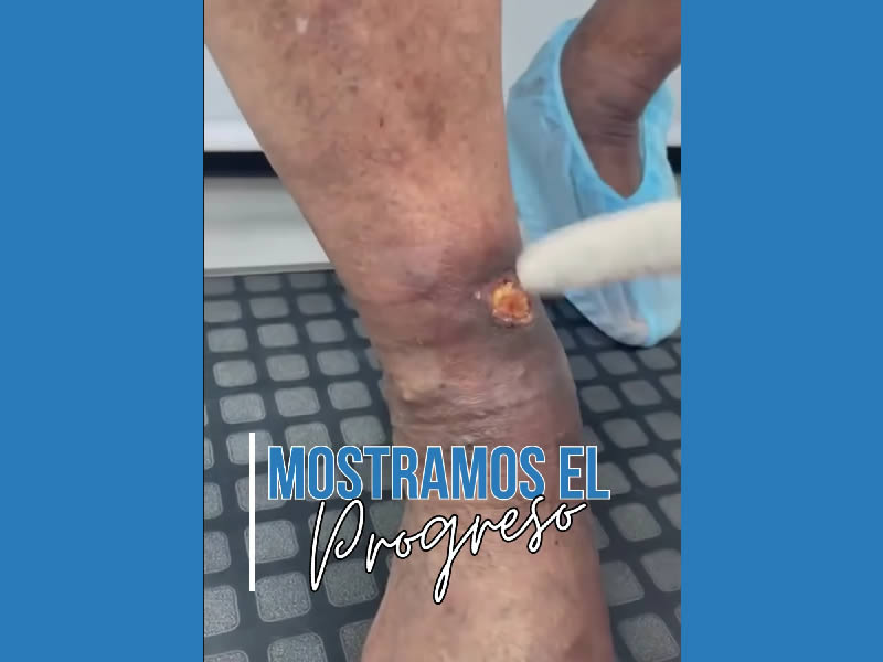 Treatment and Improvement of a Leg Affected by a Varicose Ulcer