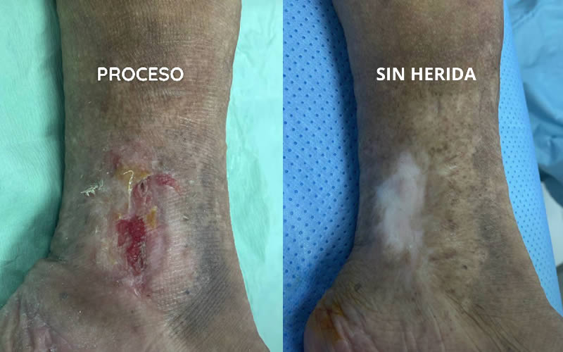 ¿Cómo se debe tratar una úlcera varicosa? ¿Cómo se debe tratar una úlcera varicosa?