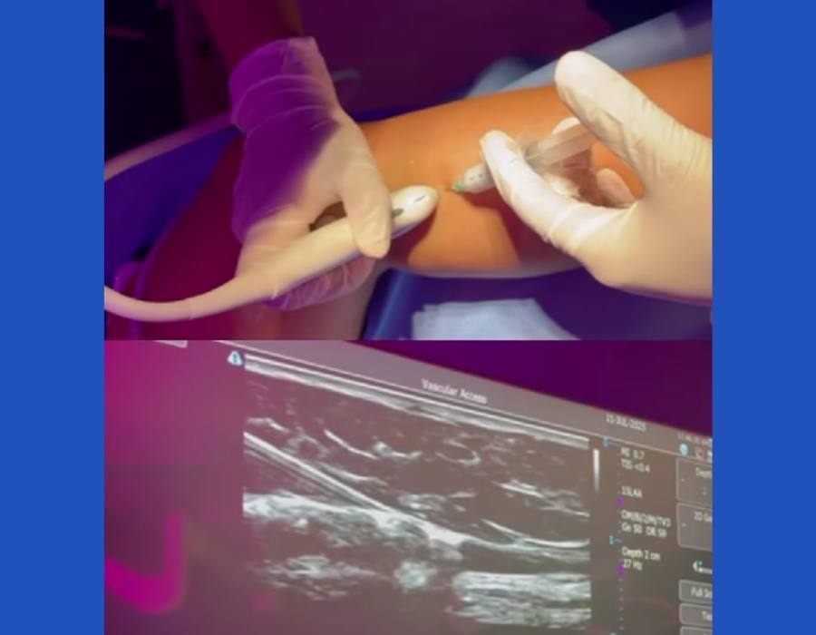 Tratamiento de Varices con EcoFoam Tratamiento de Varices con EcoFoam