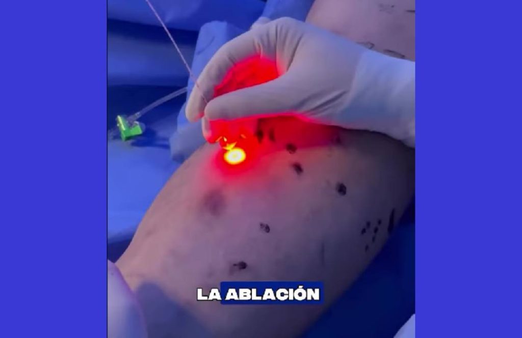 ¿El calor empeora tus várices? ¿El calor empeora tus várices?