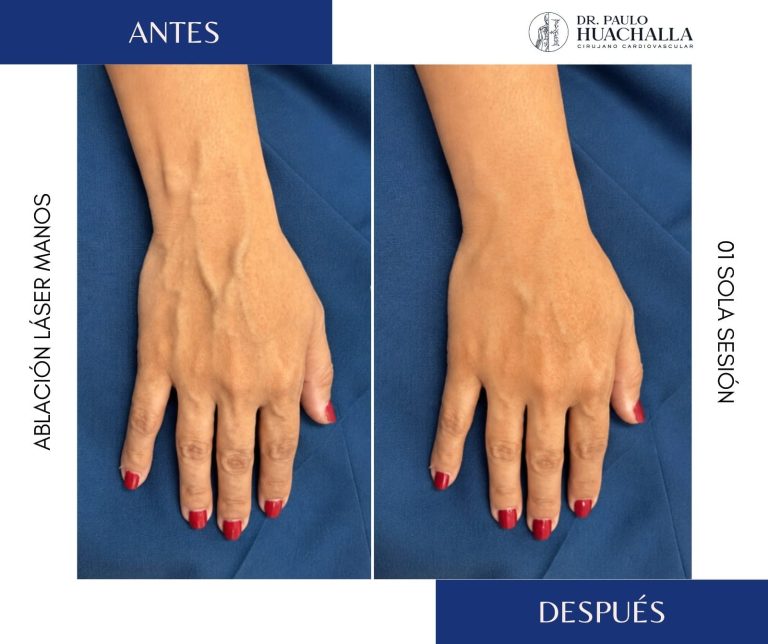 tratamientos para varices en las manos