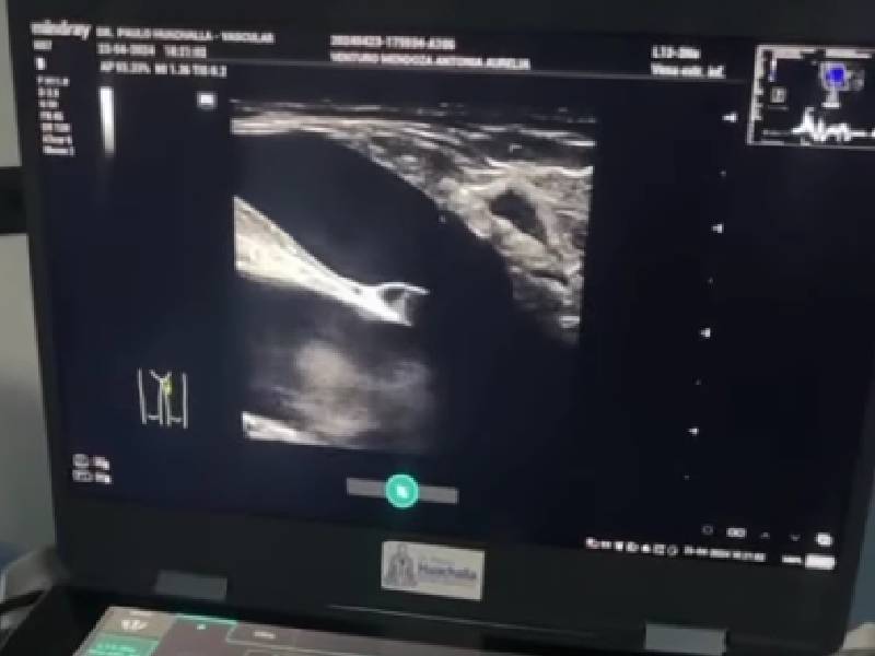 Importancia de la evaluación completa antes de diagnosticar várices