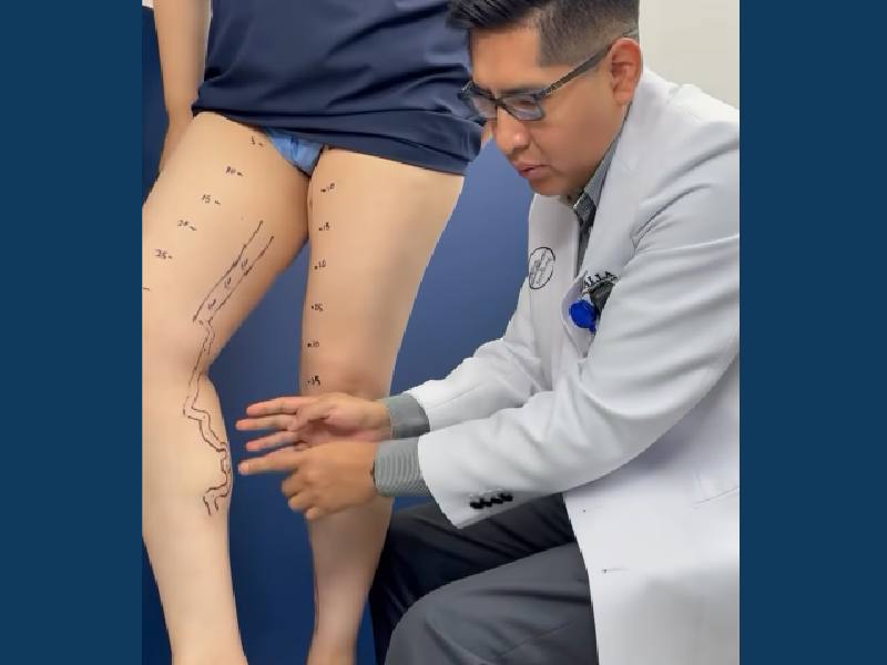 ¿Porqué aparecen várices en ambas piernas?