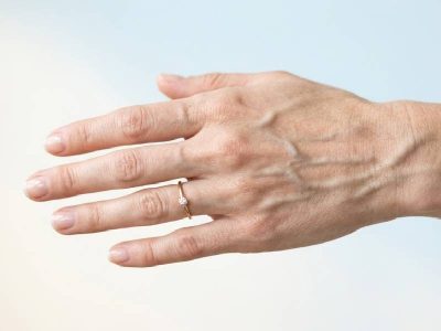 tratamiento estético para venas en las manos
